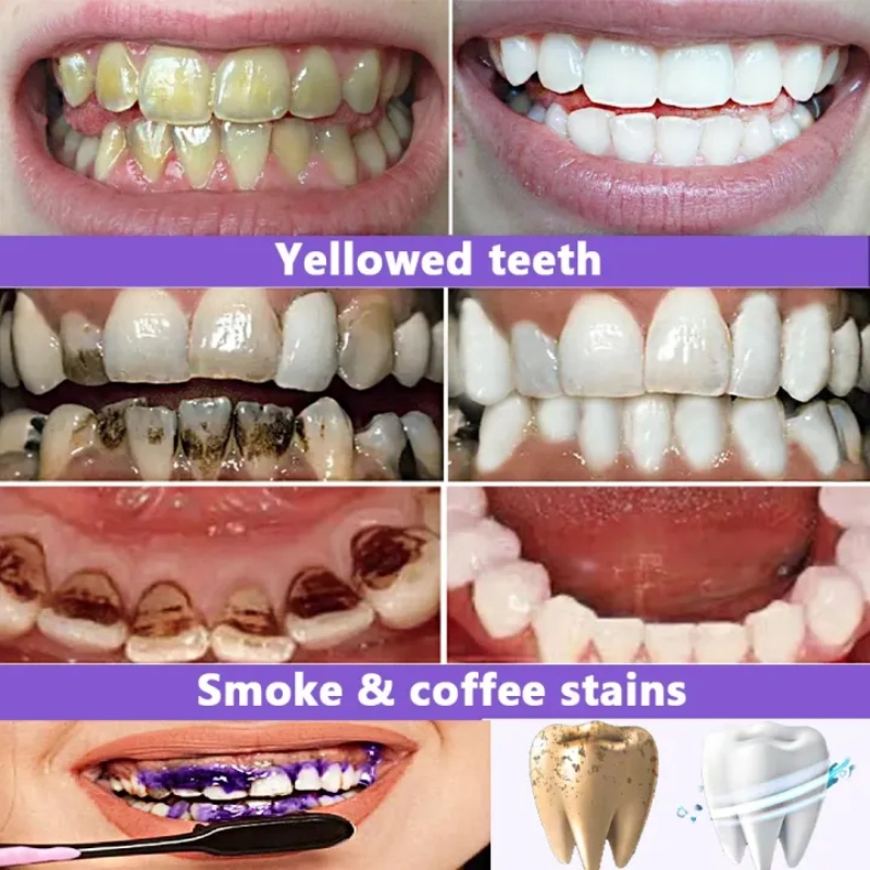 2026 Bestselling Whitening Too - Teeth Whitening Effective review and price
