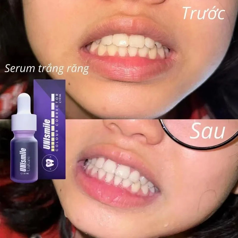 Unismile Teeth Whitening Essen - Teeth Whitening Effective review and price