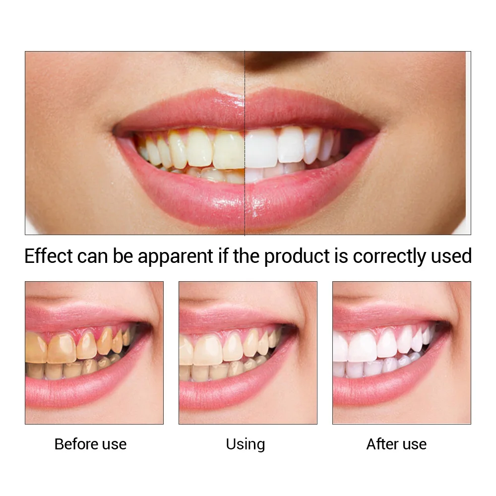 FTEENPLY Teeth Whitening Essen - Teeth Whitening Flash review and price