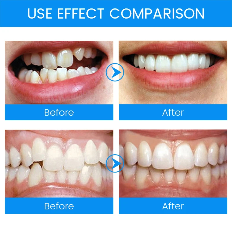 3 Stages Dental Orthodontic Br - Teeth Whitening Mouth Guard review and price